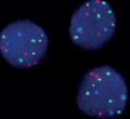 Bladder cancer - New quadruple color FISH probe